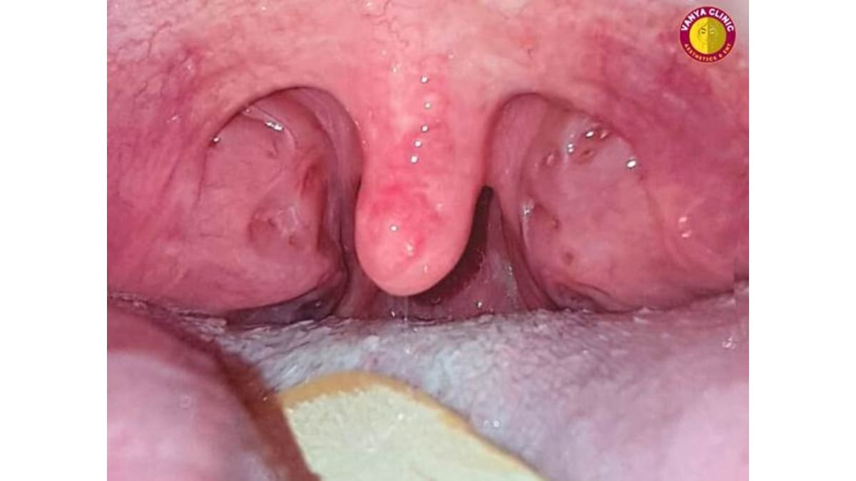 From Mama – Baba to Thank You Doctor : Dr. Purodha Prasad ENT Surgery Changes a Young Life in Delhi NCR