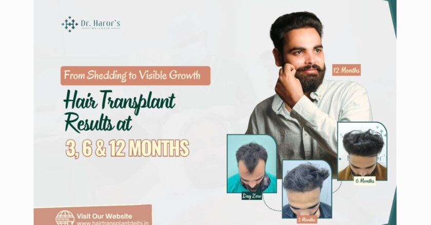 From Shedding to Visible Growth: Hair Transplant Results at 3, 6 and 12 Months